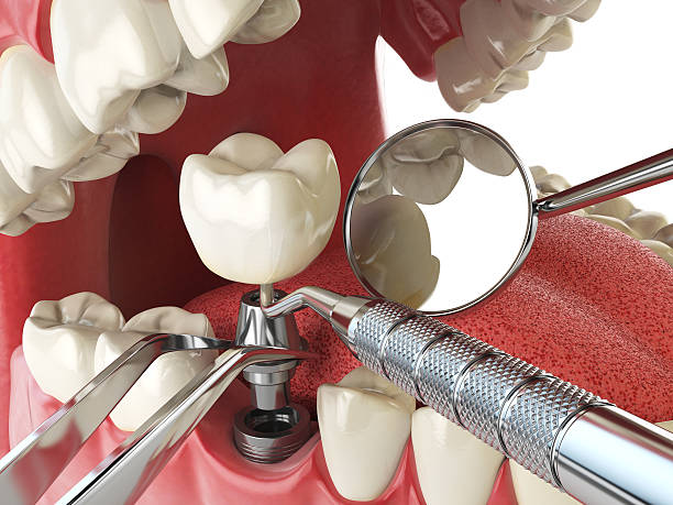 Best Dentist for Tooth Abscess  in Strasburg, VA